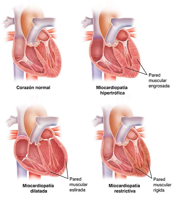 Un corazón normal junto a corazones con miocardiopatías hipertrófica, dilatada y restrictiva.